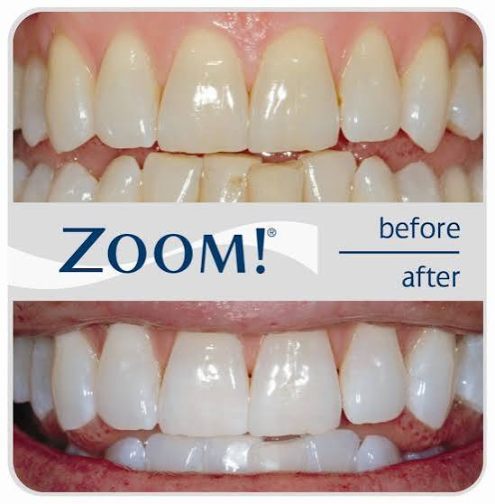 Teeth Whitening