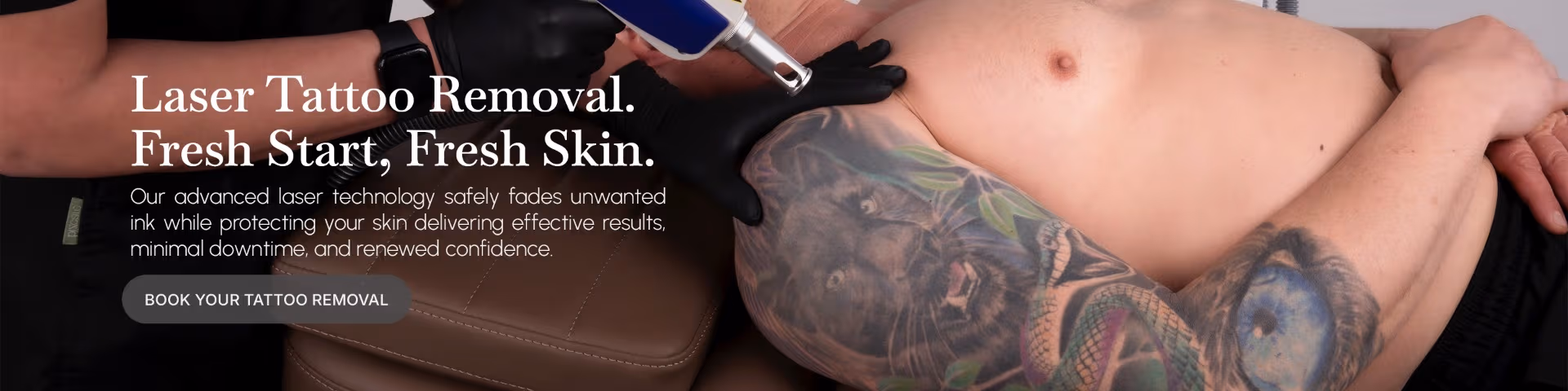 Laser Tattoo Removal