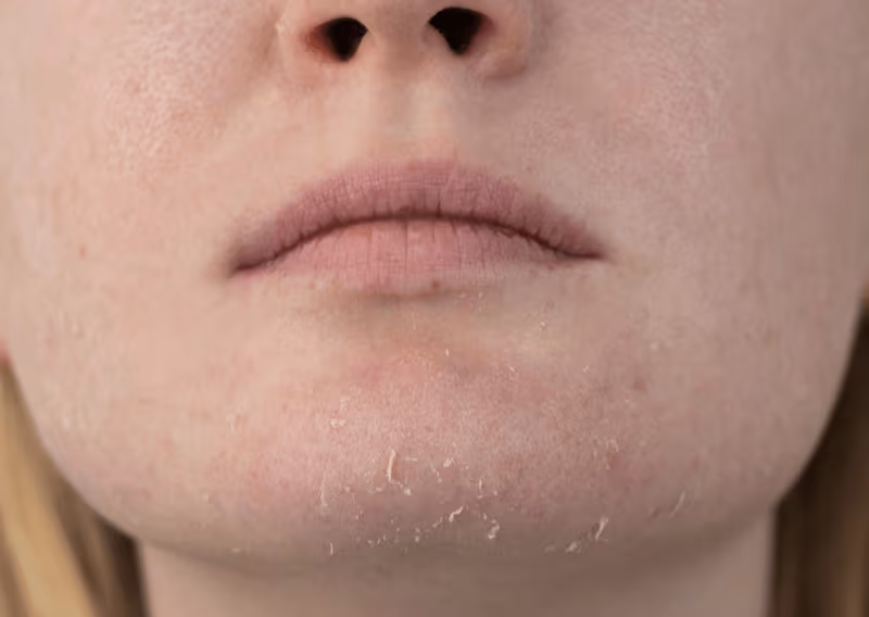 Dryness & Dehydration
