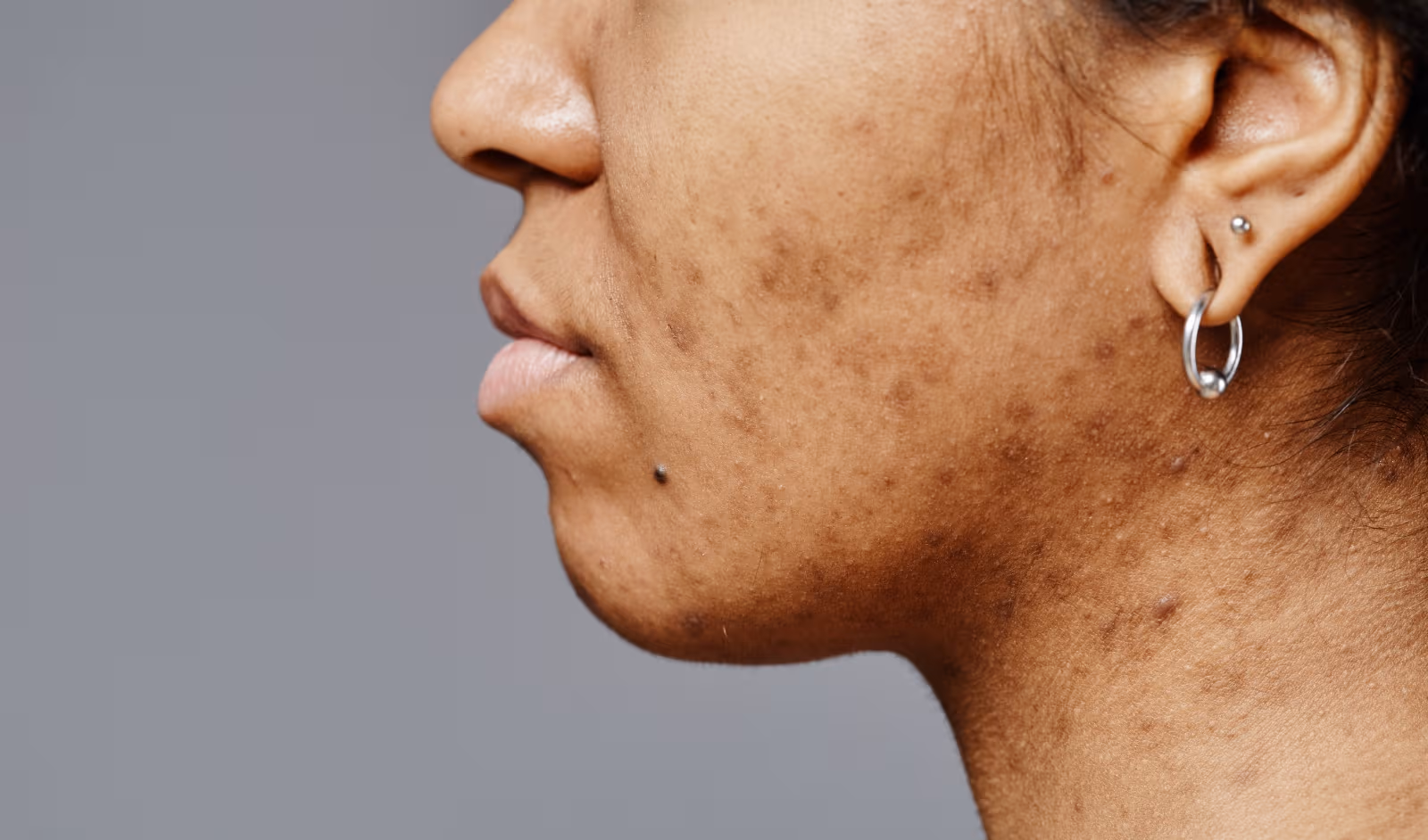 Pigmentation & Uneven Tone