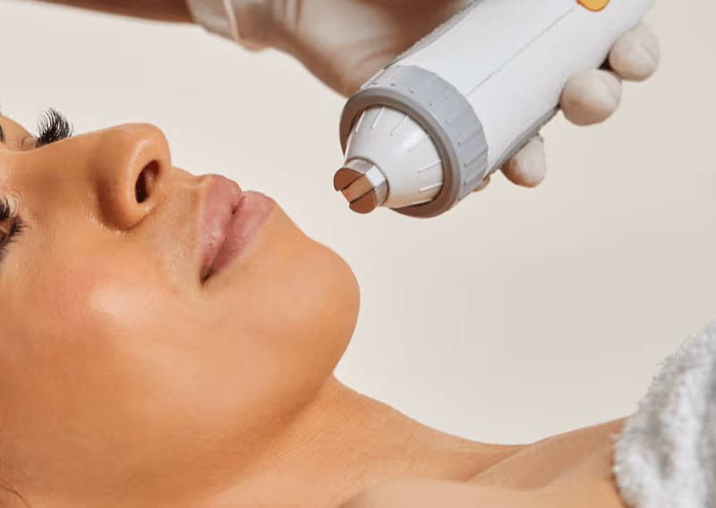 RF Skin Tightening