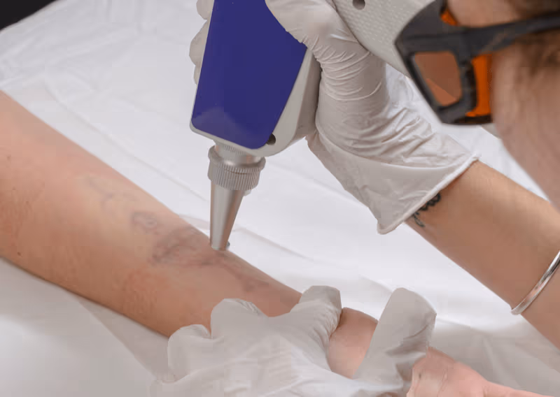 Laser Tattoo Removal