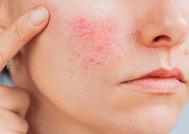 Rosacea