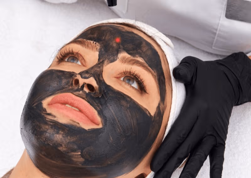 Carbon Laser Facials