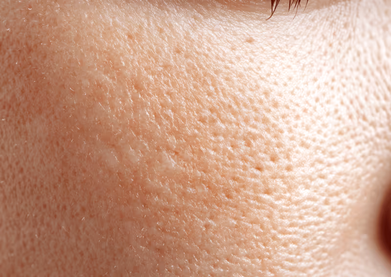 Enlarged Pores & Oily Skin