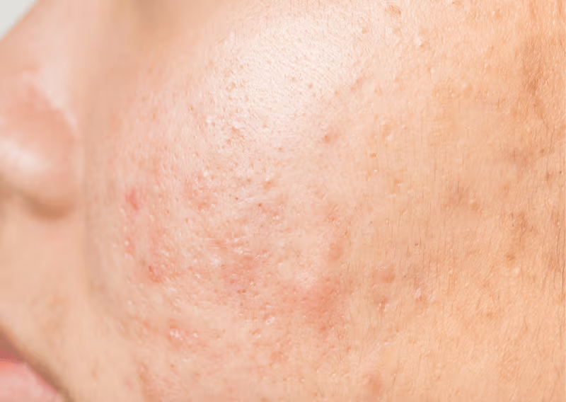 Scarring & Uneven Texture