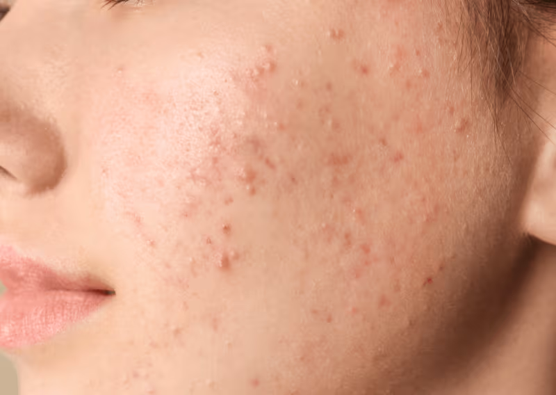 Acne & Breakouts