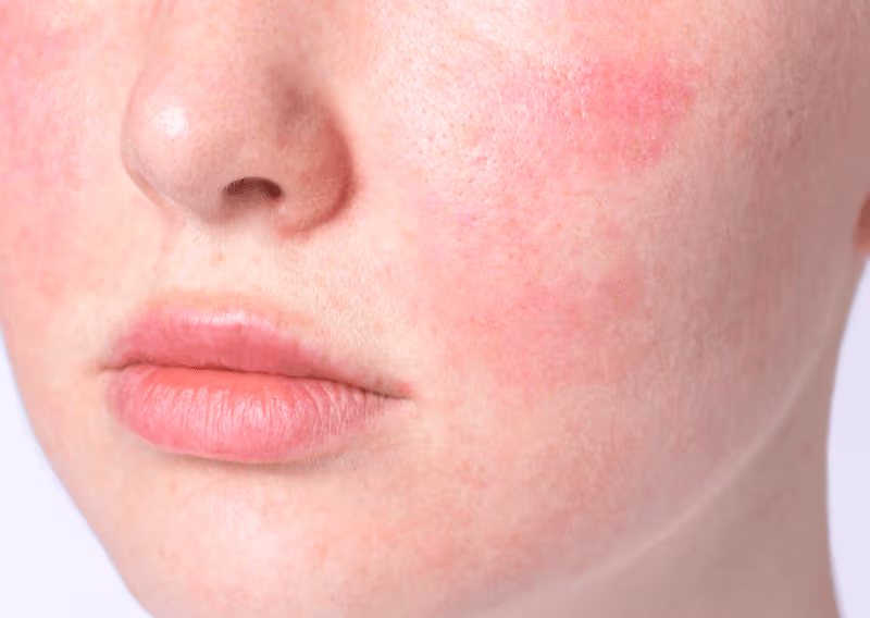 Redness & Sensitivity