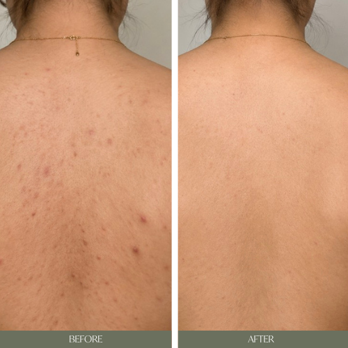 Hydrafacial Advanced Back Breakout