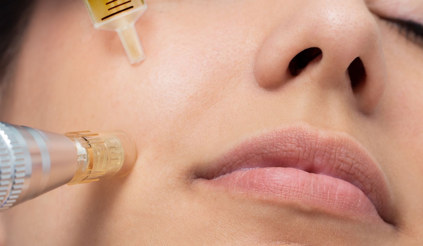 Scar MG-Infusion Needling