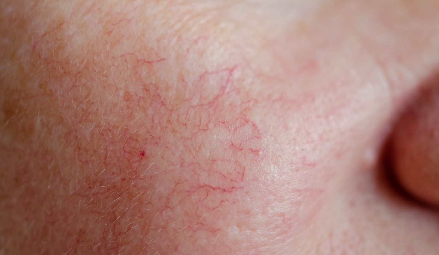 Spot Vessel Removal (-10 Lesions)