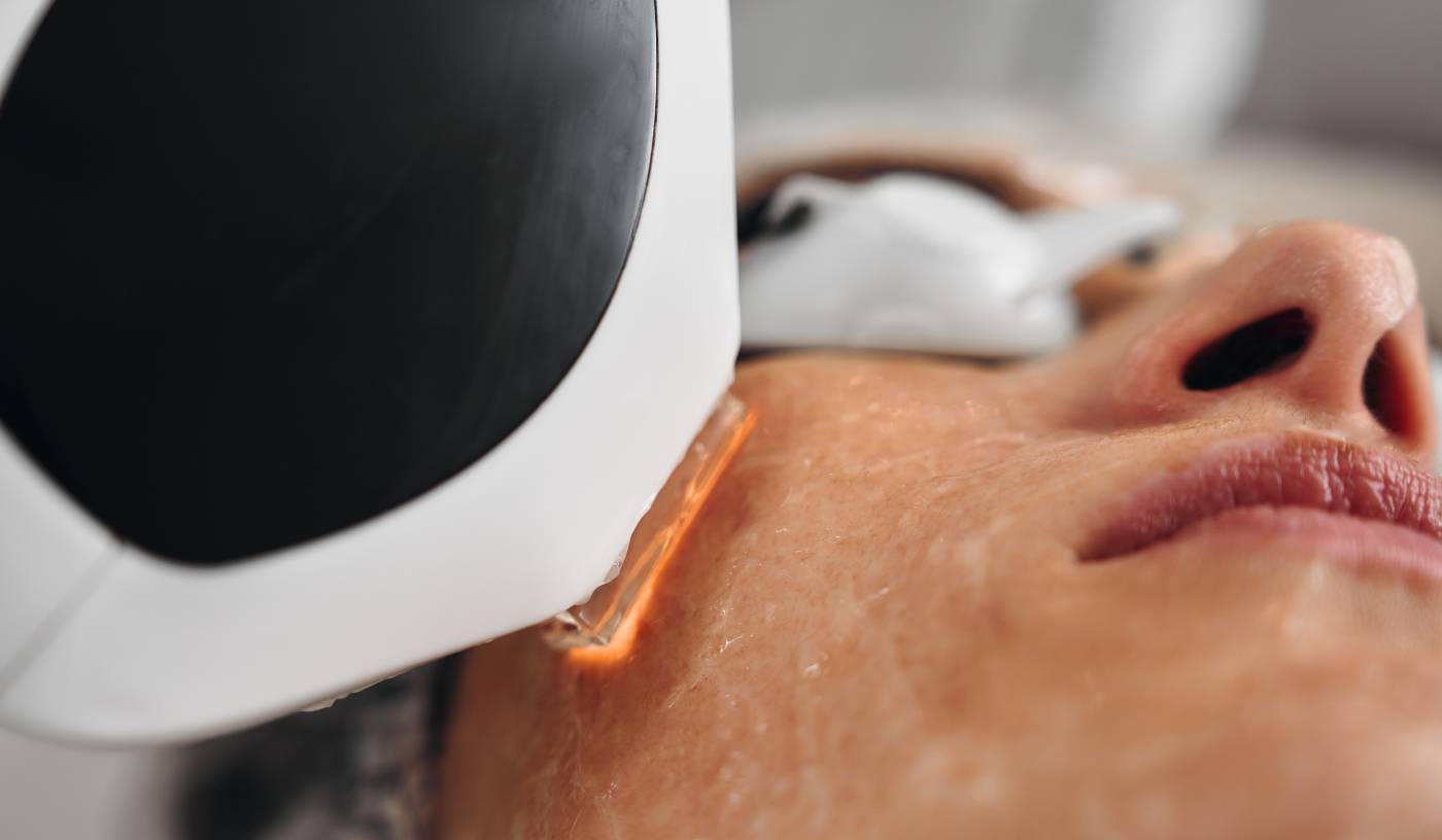 IPL Clarify Acne & Breakouts