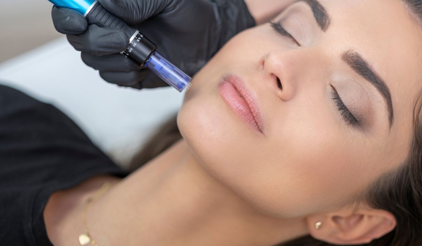 Core Radiance Needling