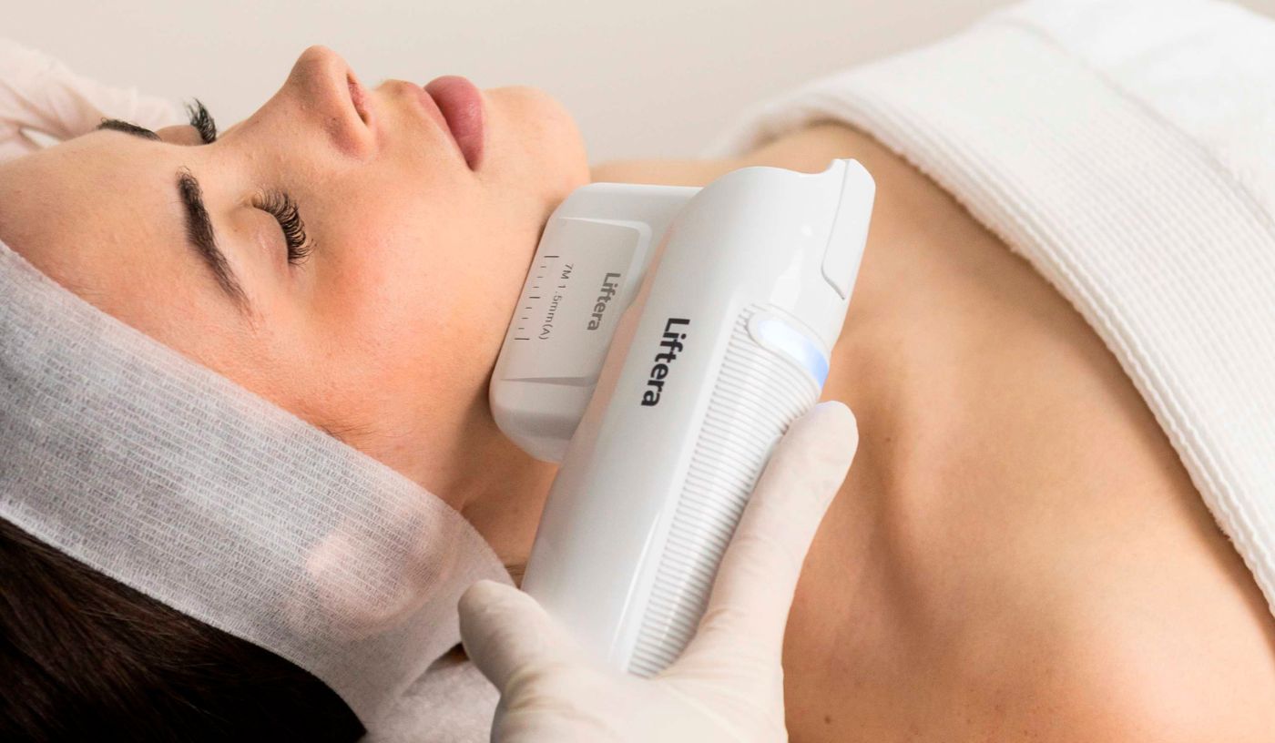 HIFU Nasolabial Fold & Cheek Lift